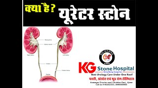 URETER STONE यूरेटर स्टोन [upl. by Llirred]