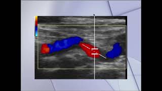 Ultrasonido Doppler Finalmente Explicado [upl. by Kcirddet693]