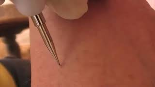 How to Use Laser Facial Mole Tattoo Removal Pen [upl. by Abihsot]