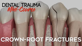 Dental Trauma MiniCourse  Part 5  Dental Trauma Guide  CrownRoot Fractures [upl. by Netram1]