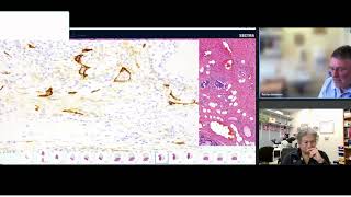 Part 3 with Adrian Bateman Adrian talks immunohistochemical techniques to detect LVI [upl. by Florri358]