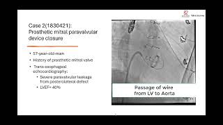 4 challenging cases in a single working day in Cathlab No 8 TAVI Paravalvular ASD and SVC [upl. by Ahsyad]