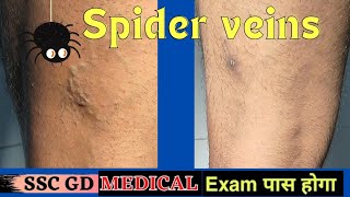 Spider veins varicose veins treatment with foam Sclerotherapy Best treatment of varicose veins [upl. by Cita]