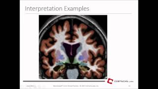 June 17 2015  Dr James Brewer UC San Diego  NeuroQuant 20 for Neurodegenerative Assessment [upl. by Ayikin]