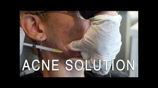 Cystic Acne Solution Kenalog Injection [upl. by Kirimia]