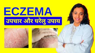 Eczema Treatment  Eczema Ka Ilaj Home Remedies Aur Precautions [upl. by Heringer]