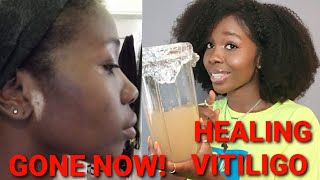 HEALING MY VITILIGO NATURALLY 🙌🏾🙌🏾 [upl. by Nnyleitak]