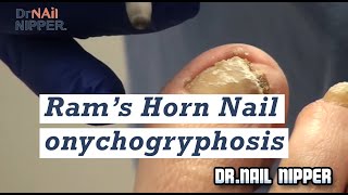 Rams Horn Nail onychogryphosis trimming in podiatry office [upl. by Stutman]