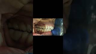 First and second mandibular molar implant bridge occlusal check for interference shorts [upl. by Millar973]