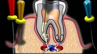 Complicazioni di canale radicolare [upl. by Elsilrac]