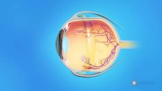 What is scleral buckle surgery [upl. by Atsirhcal647]