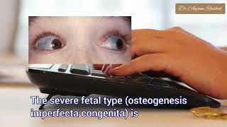 Osteogenesis Imperfecta Symptoms Cause Genetics Radiology amp Treatment  Brittle Bone Disease [upl. by Ahsoet]