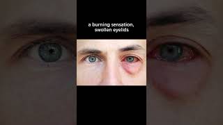 What Are the Symptoms of Eye Allergies [upl. by Suoirtemed]