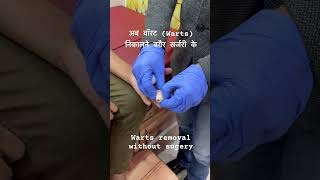 Warts removal without surgery [upl. by Goodyear]