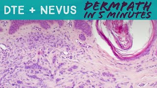 Desmoplastic Trichoepithelioma plus Nevus Dermpath in 5 Minutes dermatology pathology adnexal [upl. by Campbell]