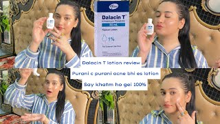 Dalacin T Lotion Review Bye bye Acne 😡 say Hi to new skin❤️Best Acne lotion 100 guaranteed results [upl. by Vez143]