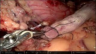 Robotic Harvesting of Pedicled Omental Flap [upl. by Sollie]