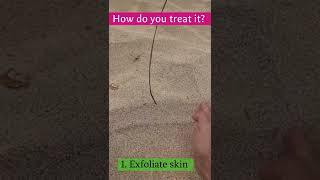 Doctor V  How To Treat Ingrown Hairs  Skin Of Colour  Brown Or Black Skin [upl. by Alberto820]