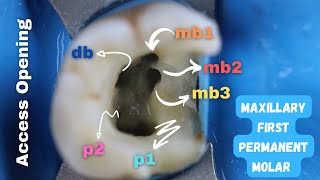 How To Find Mesiobuccal Canals mb1mb2mb3 Easily 🟡 Access Opening iin maxillary first molar [upl. by Ardried]