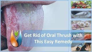 Get Rid of Mouth Thrush with This Easy Remedy [upl. by Rhys]