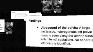 Carcinosarcoma of the ovary malignant mixed Müllerian tumor of the ovary [upl. by Eecal]