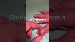 Gouty Tophi  my oh my… Have no doubt this is gout  this is what happens with end stage Gout [upl. by Curren]