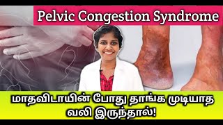 மாதவிடாயின் போது தாங்க முடியாத வலி Pelvic congestion syndrome அறிகுறி  DrJagadeeswariRajalingam [upl. by Abbye133]