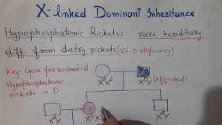 X Linked Dominant Inheritance  Hypophosphatemic Ricket  Vitamin D Resistance Rickets [upl. by Konopka]