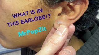 Chronic inflammatory earlobe nugget excised You can see scar ingrown hair and cyst formation [upl. by Aim341]