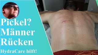 HydraCare Behandlung für Pickel und Juckreiz auf dem Männerrücken  BodyDream Kosmetikstudio [upl. by Britt]