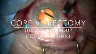 Core Vitrectomy During 25 gauge Vitrectomy Surgery [upl. by Skyler]