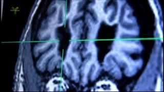 Transorbit lobotomy and MRI examination of living lobotomized patients brain [upl. by Willms]