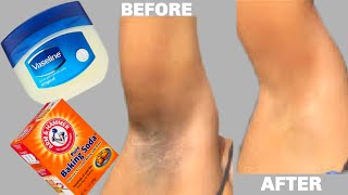 HOW TO LIGHTEN DARK UNDERARMS AND THIGHS IN JUST 3 MINUTES USING BAKING SODA AND VASELINE [upl. by Dalton324]