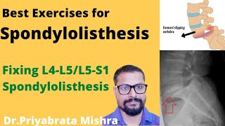 Best Exercises For SpondylolisthesisTop way to Correct AnterolisthesisL4L5S1 [upl. by Lydnek311]