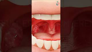 Tonsil Removal Surgery ↪ 3D Medical Animation Tonsil Tonsillectomy Surgery Shorts [upl. by Editha233]