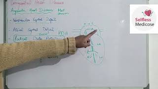 FCPS part 1CVS lecture 20 ACYANOTIC HEART DISEASES made easy [upl. by Nawek]