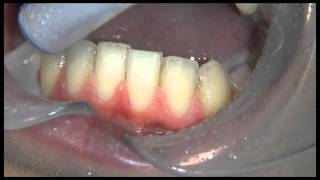 AquaCare Bioactive Glass and Ortho Resin Removal Without Damaging Teeth [upl. by Drawyah182]