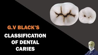 Classification of Dental Caries  GV Blacks Classification [upl. by Aicnetroh654]