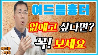 여드름 흉터❗없애고 싶다면❓꼭❗보세요 여드름흉터 여드름흉터없애는방법 여드름흉터없애는법 여드름자국 [upl. by Nylahs]