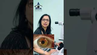 Laser for Glaucoma YAG Iridotomy [upl. by Sac557]