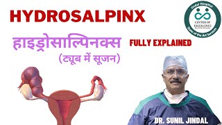 Hydrosalpinx हाइड्रोसाल्पिनक्स ट्यूब में सूजन [upl. by Leinahtam750]