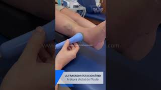 Tratamento conservador de fratura distal de fíbula [upl. by Anitsud]