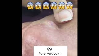 Pore Vacuum Pro in Use [upl. by Rovelli456]