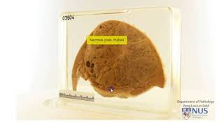 Liver  Hepatoblastoma [upl. by Samanthia740]