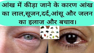 आंख में कीड़ा चला जाए तब करे ये इलाज। eye in insect then take the proper treatment in hospital [upl. by Adnim85]