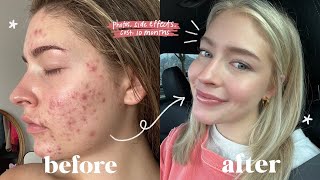 MY FULL ACCUTANE JOURNEY  side effects cost will it come back [upl. by Nnahtebazile925]