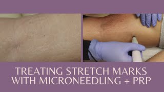 Treating stretch marks with Microneedling  PRP [upl. by Seys]