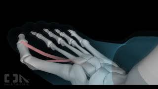 MinimallyInvasive Hallux Valgus Bunion Surgery [upl. by Chaney]