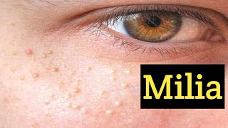 what is Milia can we removed milia with home remedies  cause treatment if milia [upl. by Ltney]