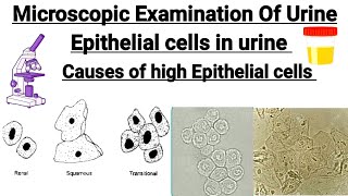 Causes of high Epithelial cells in urine  Microscopic examination of urine  Epithelialcells [upl. by Hirza]